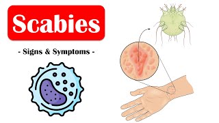 Scabies  Signs amp Symptoms What Are The Commonest Signs amp Symptoms Of Scabies [upl. by Annahsar]