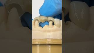 Terrific Zirconia Bridge with a Veneer ​⁠EnvisiontecMain envisiontec lsk121shorts dentist [upl. by Far666]