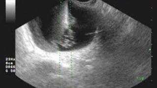 SONOGRAPHY GUIDED OVARIAN CYST ASPIRATION [upl. by Mcloughlin]