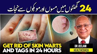 Get Rid of Skin Warts and Tags in 24 Hours 24 گھنٹوں میں مسوں اور موہکوں سے نجات by drjeelani [upl. by Royce90]