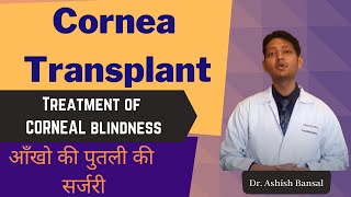 Cornea Transplant Eye Surgery Corneal Blindness treatment  आँखो की पुतली बदलने की सर्जरी [upl. by Andersen]