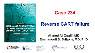 Case 234 Flush aortoostial CTO [upl. by Vasti361]