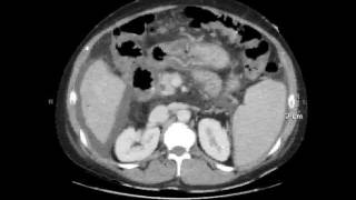 portal enteropathy [upl. by Godric]