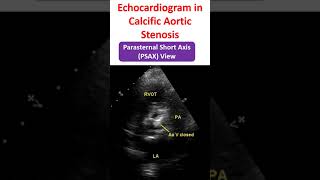 Echocardiogram in Calcific Aortic Stenosis [upl. by Dahcir415]