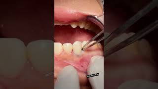 Scaling and Root Planing for Gum Disease MouthHealthy tartar teethscalling dental dentist toot [upl. by Niven]