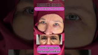 Qovoq olish  қовоқ олиш  blefaroplastika Doctor ODILJON 998974347791 TOSHKENT VA JIZZAXDA rek [upl. by Vilhelmina]