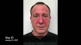 Actinic Keratosis Fluorouracil Treatment 27Day Time Lapse [upl. by Hendry762]