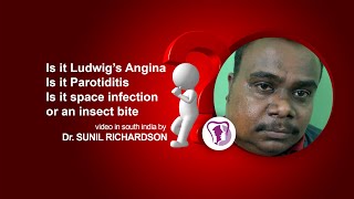 Is it Ludwig’s Angina Is it Parotiditis Is it space infection or an insect bite [upl. by Lazos]