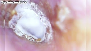 Ear Wax Removal  127 His Earwax Is Infected With White Yeast  Ear Cleaning ASMR [upl. by Nahshu947]