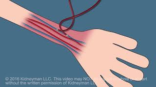 Dialysis Fistula animation [upl. by Abekam]