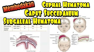 Membedakan Caput Succedaneum Cephal Hematoma dan Subgaleal Hematoma UKMPPD Pediatri Neonatologi [upl. by Ecinwahs]