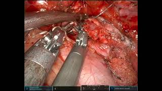 URATS left main bronchus sleeve resection and second carinal reconstruction for carcinoid tumor [upl. by Bramwell576]