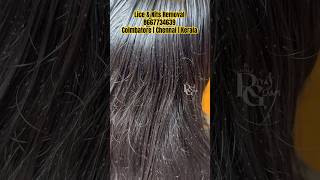 Lice nits removal treatment in parlour Tamilhoe to remove nits from hairlice removalhow to [upl. by Epperson]