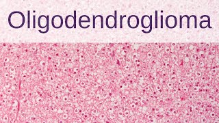 Oligodendroglioma  Pathology mini tutorial [upl. by Orbadiah695]