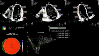 A Practical Guide to Echocardiographic Global Longitudinal Strain GLS by 2D Speckle Tracking [upl. by Suoicerp]