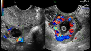 CORPUS LUTEUM VS ECTOPIC PREGNANCY [upl. by Toile]