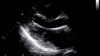 Constrictive Pericarditis Following Heart Transplant 1 [upl. by Aihsemaj]