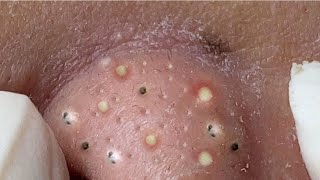 Relax Every Day With Loan Nguyen Spa  Acne Treatment Pimple Popping 33 [upl. by Nirb]