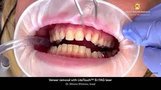 Veneer removal with LiteTouch™ ErYAG laser [upl. by Letrice]