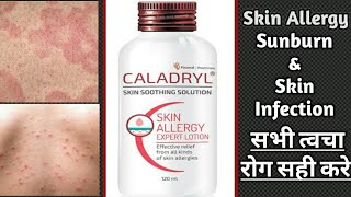 Caladryl Skin Soothing Lotion Review  Skin allergy infection itching amp Sunburn medicine [upl. by Ahsenat756]