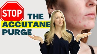 Accutane Acne Purge Do THIS [upl. by Ame]