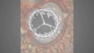 Effect of dual antiplatelet therapy versus anticoagulation 6 [upl. by Anwaf767]