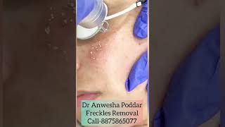 Freckle Removal in Gurgaon For an appointmentCall on 8875865077 or visitwwwdranweshapoddarcom [upl. by Enavi]