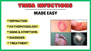 Tinea infection fungal skin infection types of tinea pathophysiology diagnosis treatment [upl. by Nelleoj442]