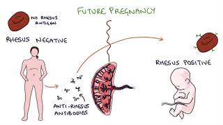 Understanding Rhesus Status and AntiD in Pregnancy [upl. by Nossah931]