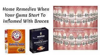 Home Remedies When Your Gums Start To Inflamed With Braces [upl. by Yllor]