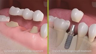 Straumann  Behandeling met een driedelige brug amp Implantaatbehandeling bij een ontbrekende tand [upl. by Buford933]