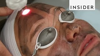 Get Glowing Skin With A Laser Facial [upl. by Jc]