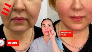 EFFECTIVE TECHNIQUES FOR THE NASOLABIAL FOLDS  NO WORDS [upl. by Nnylrebma637]