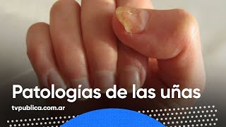 Salud Patologías de las Uñas  Mañanas Públicas [upl. by Fachanan380]