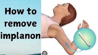 How to remove contraceptive implanonMethod of contraceptive implants removal [upl. by Namsaj236]