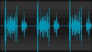 Abnormal heart soundMurmur Aortic Stenosis [upl. by Lorolla]