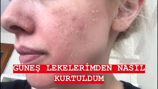 EYLÃœL Ã–ZTÃœRKGÃœNEÅ LEKELERÄ°MDEN NASIL KURTULDUMCÄ°LTBAKIMI [upl. by Llertal445]