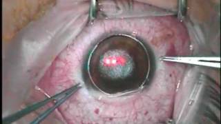 Intralase LASIK in a case with nystagmus [upl. by Hoem677]