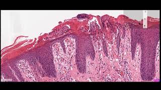 dermatopathology of psoriasis [upl. by Ididn]