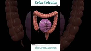 Colon Volvulus [upl. by Nylatsirk182]