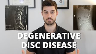 Overcome Degenerative Disc Disease [upl. by Nohtanoj]