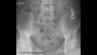 Posterior Sacral Anatomy  Two Malformations of the Lumbosacral Joint Sacralization  Lumbarization [upl. by Harbert209]