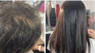 Micro Hair Topper Integration a more permanent non surgical solution for thinning hair [upl. by Zahc]