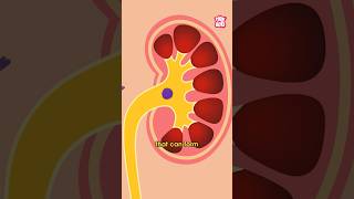 What Causes Kidney Stones  World Kidney Day Special shorts kidneystone worldkidneyday [upl. by Nahgeam]