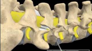 Lumbar Spine Epidural Steroid Injection Block transforaminal attorney videos [upl. by Nrubyar]