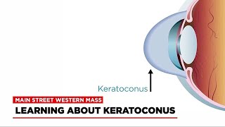 West Springfield ophthalmologist helping diagnose and treat keratoconus [upl. by Alabaster]