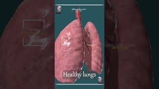 Smokers Lungs 🚭 VS Non Smokers Lungs 🫁 [upl. by Binky]