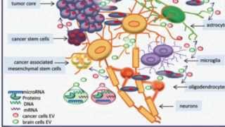 Advancing the Treatment of Malignant Gliomas Glioblastoma Video – Brigham and Women’s Hospital [upl. by Inahet]