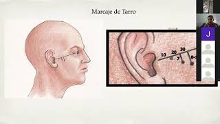 Artroscopia de ATM Victor Hugo Gonzalez TMJ Artrhoscopic webinar presentation [upl. by Cumine]