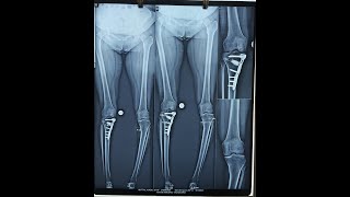 HTO HIGH TIBIAL OSTEOTOMY [upl. by Clark]